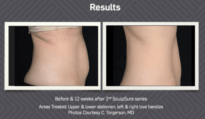 SculpSure before and after Calgary medi spa