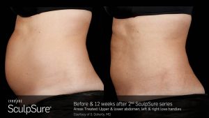 Sculpsure before and after