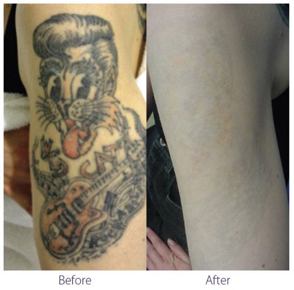 Laser Tattoo Removal in Dubai, UAE - Men & Women