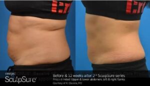body contouring with Sculpsure Calgary