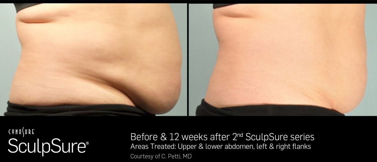 before and after sculpsure feb 22 newsletter