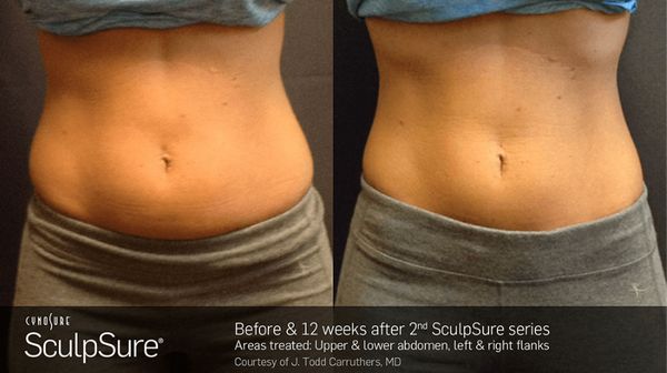 BODY CONTOURING - NuCurves Body Contouring