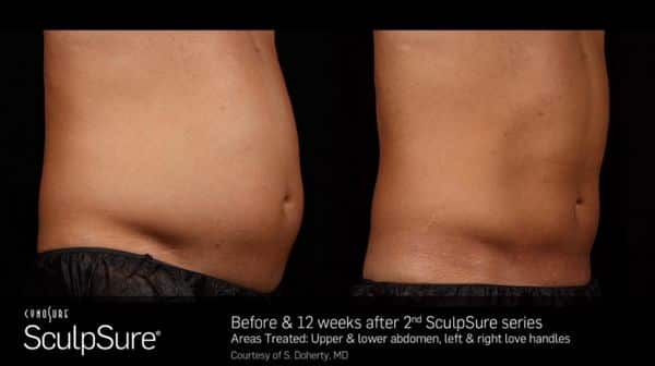 BODY CONTOURING - NuCurves Body Contouring