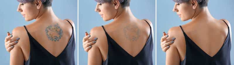 Laser tattoo removal Calgary - 5 important facts