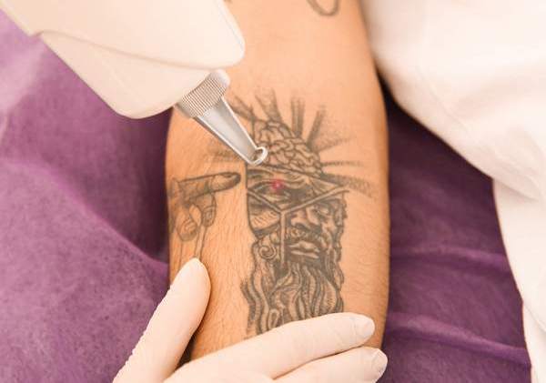 The Latest Laser Removal Technology Means Tattoos Don't Have to Be for Life  — Posh Lifestyle & Beauty Blog