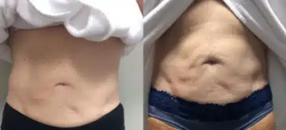 TempSure Firm abdomen treatments before and after images